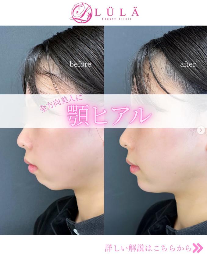 アゴクレヴィエルの症例写真