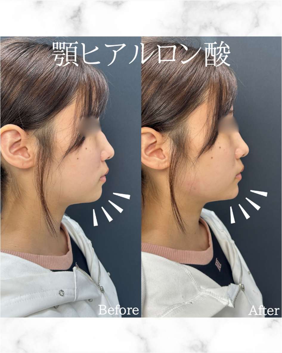 アゴクレヴィエルの症例写真