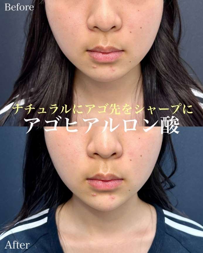 アゴクレヴィエルの症例写真