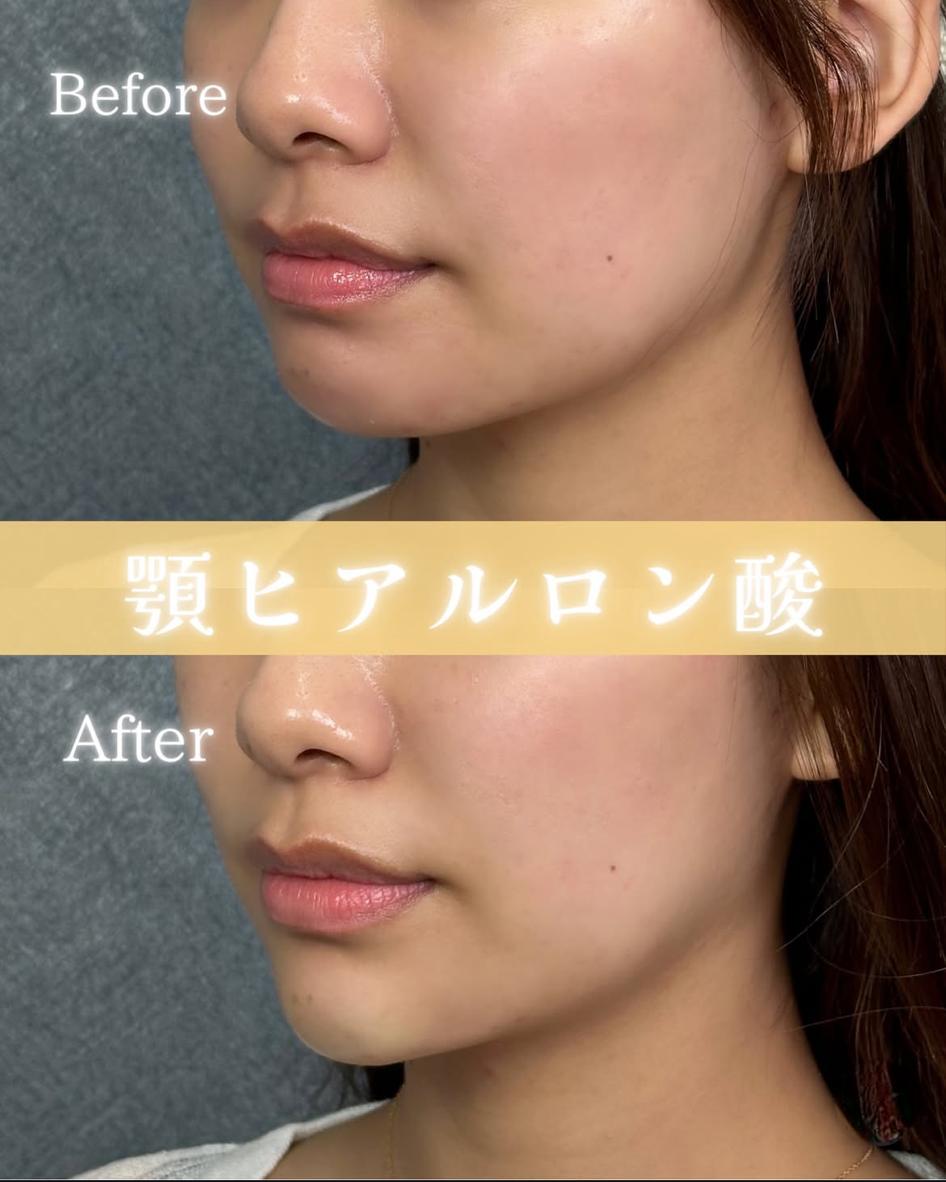 アゴクレヴィエルの症例写真