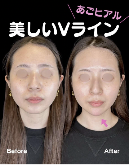 アゴクレヴィエルの症例写真