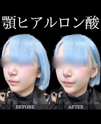 アゴクレヴィエルの症例写真