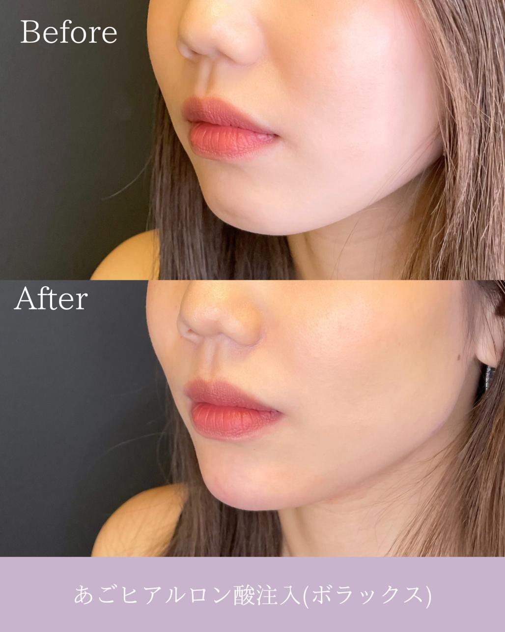 アゴクレヴィエルの症例写真