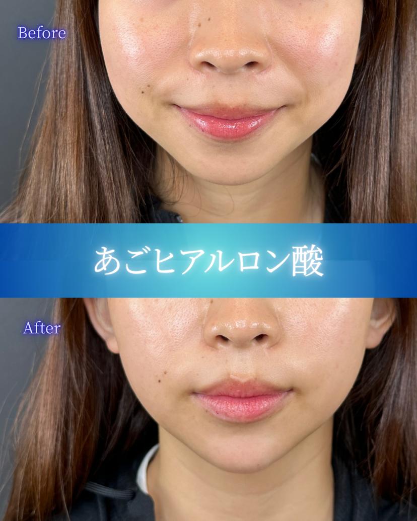 アゴクレヴィエルの症例写真