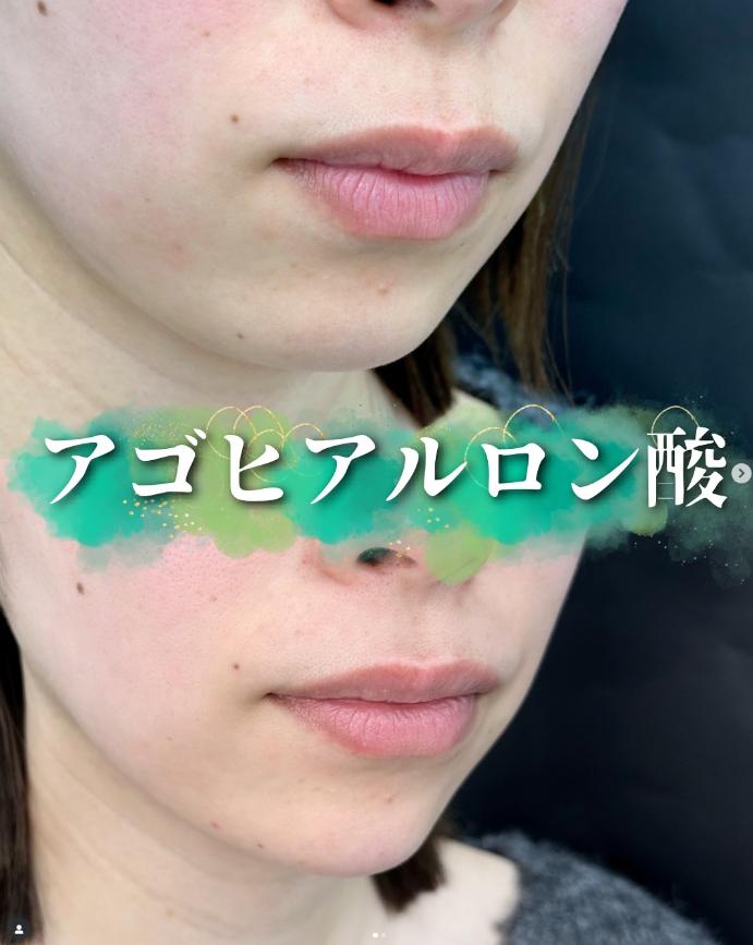 アゴクレヴィエルの症例写真