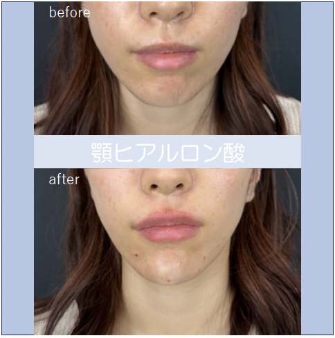 アゴクレヴィエルの症例写真