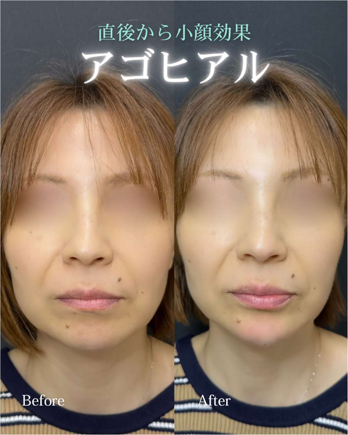 アゴクレヴィエルの症例写真