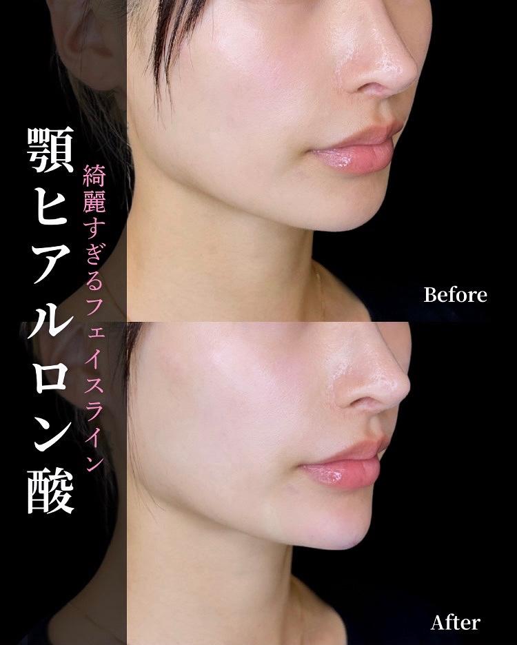 アゴクレヴィエルの症例写真