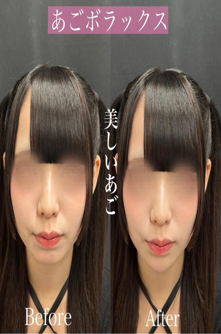 アゴクレヴィエルの症例写真