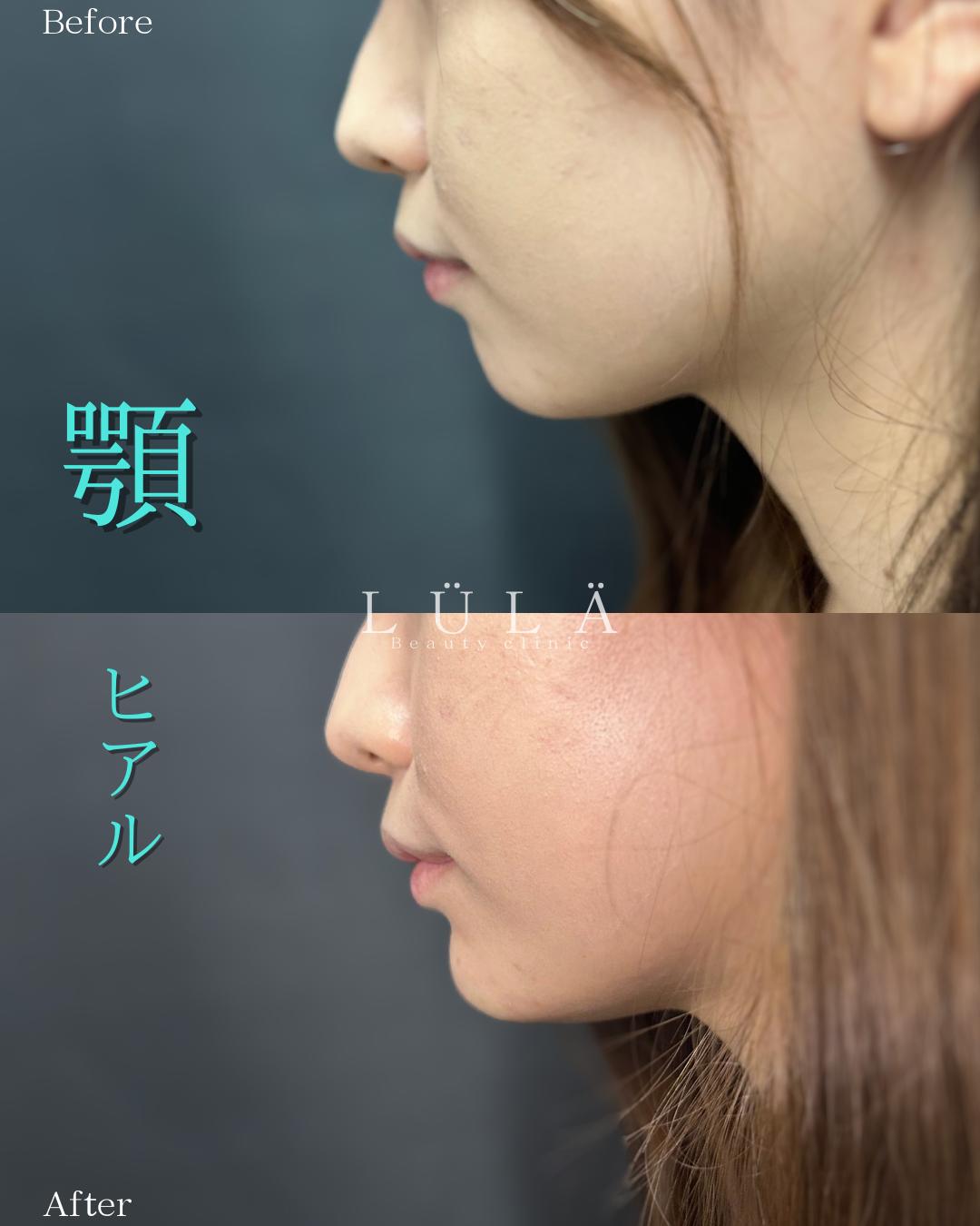 アゴクレヴィエルの症例写真