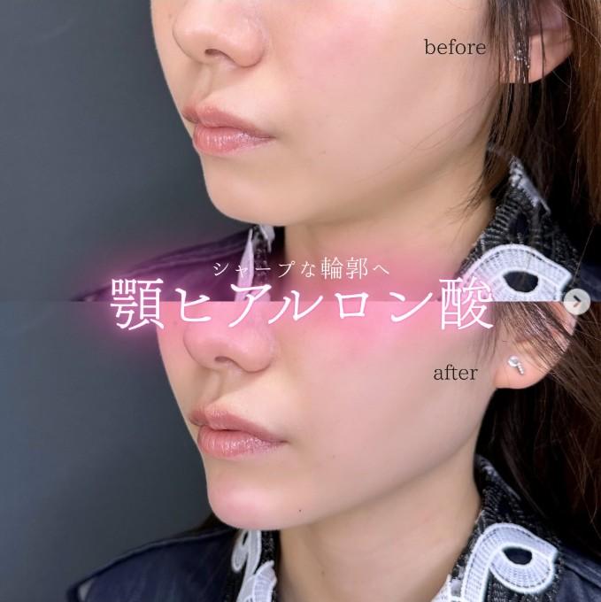 アゴクレヴィエルの症例写真