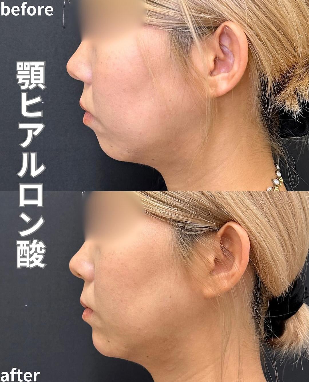 アゴクレヴィエルの症例写真