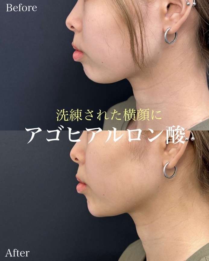 アゴクレヴィエルの症例写真