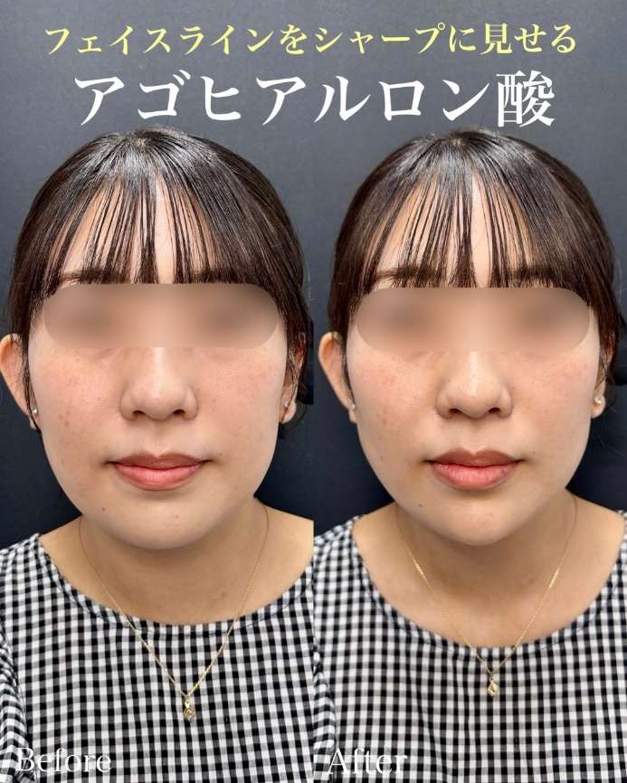 アゴクレヴィエルの症例写真