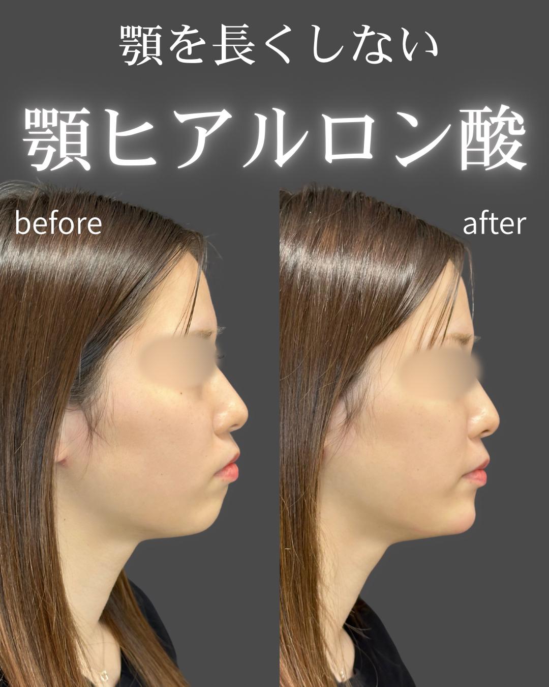 アゴクレヴィエルの症例写真