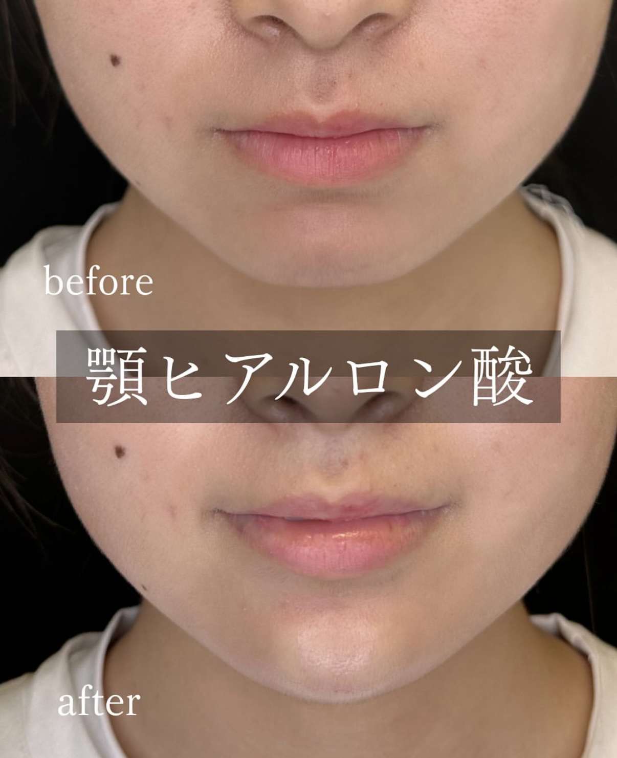 アゴクレヴィエルの症例写真