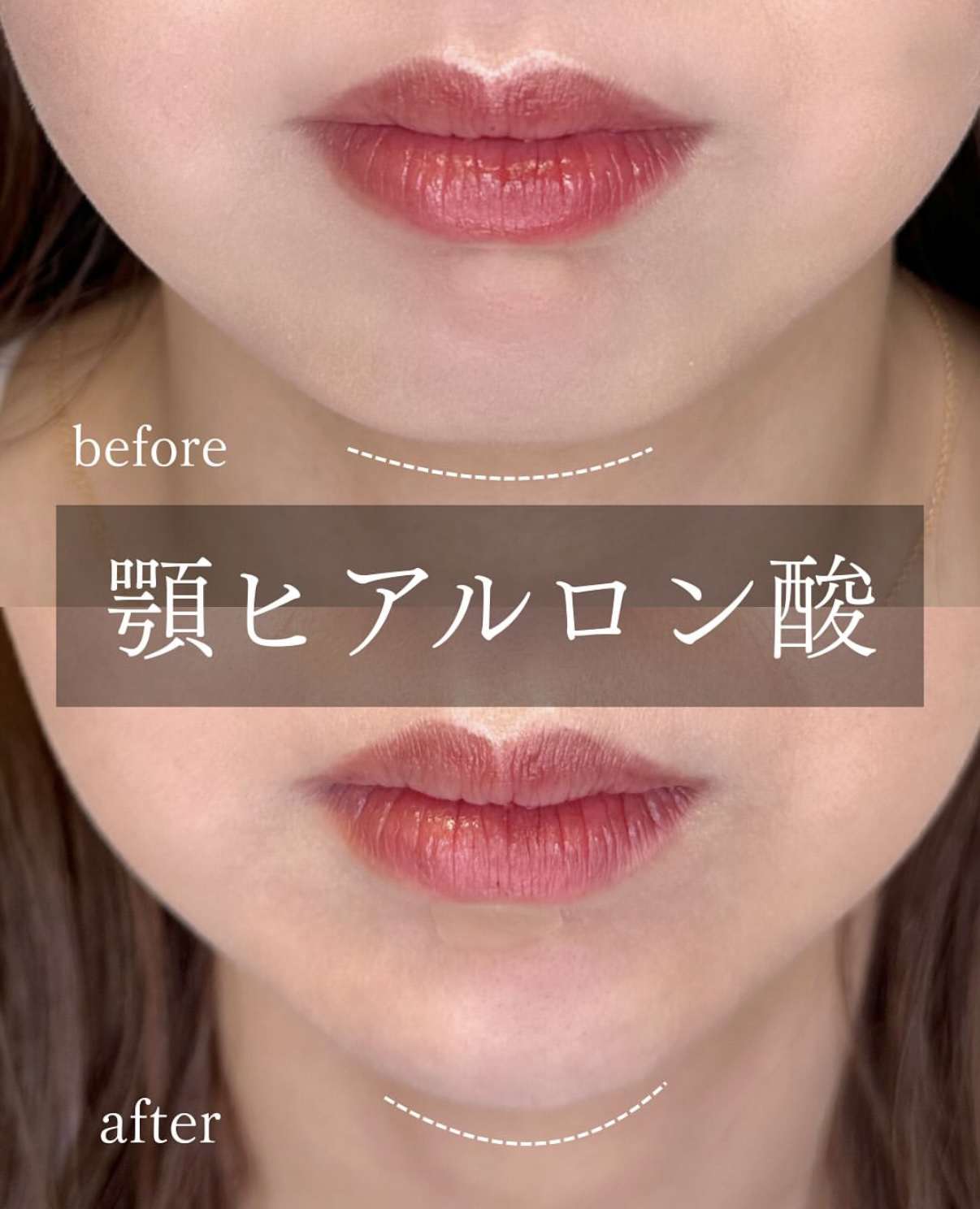 アゴクレヴィエルの症例写真