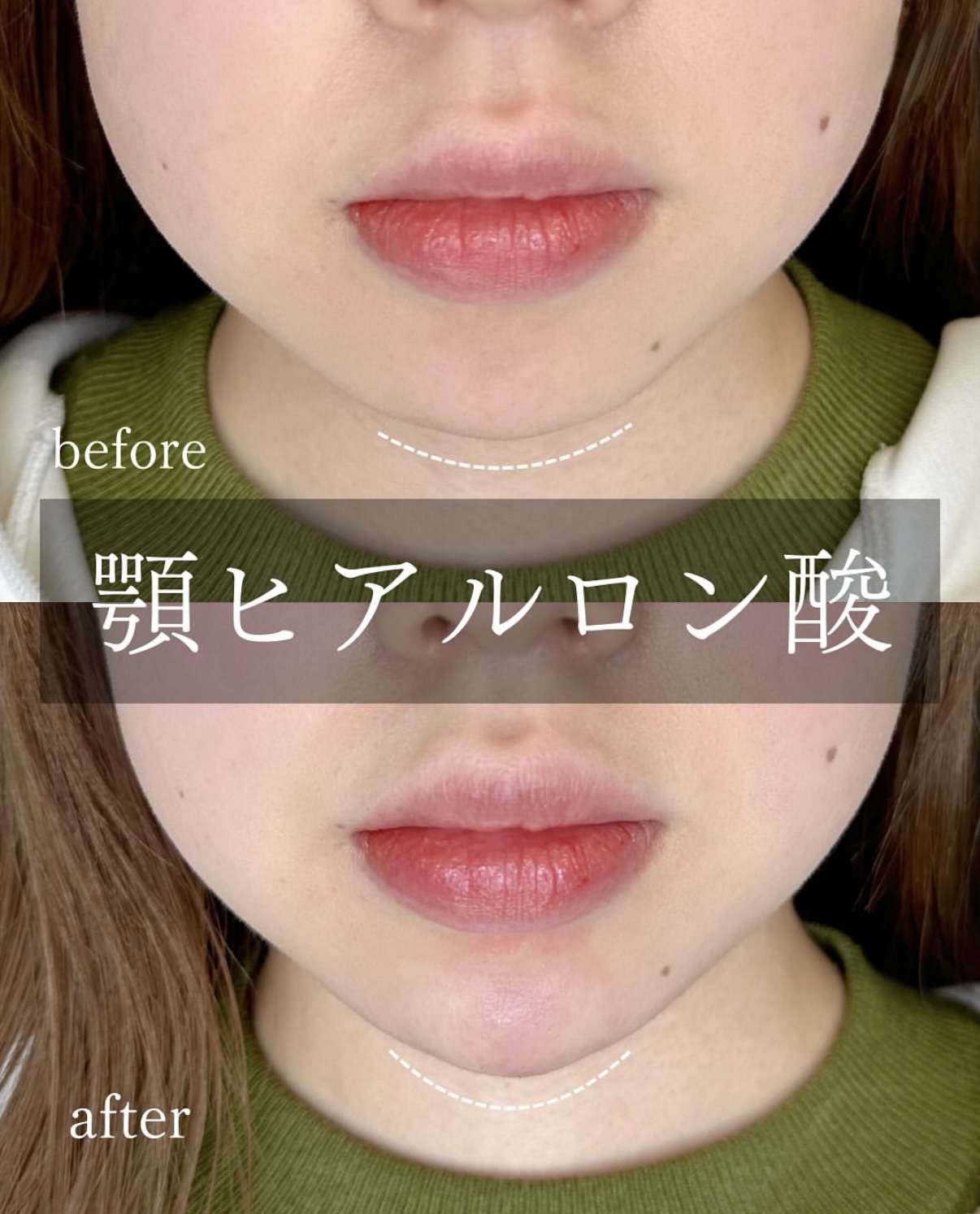 アゴクレヴィエルの症例写真