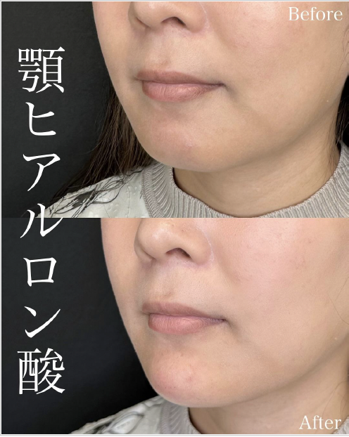 アゴクレヴィエルの症例写真