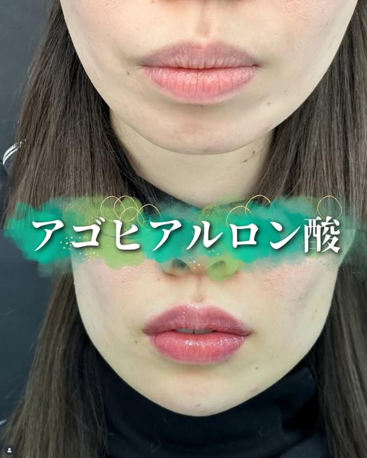 アゴクレヴィエルの症例写真