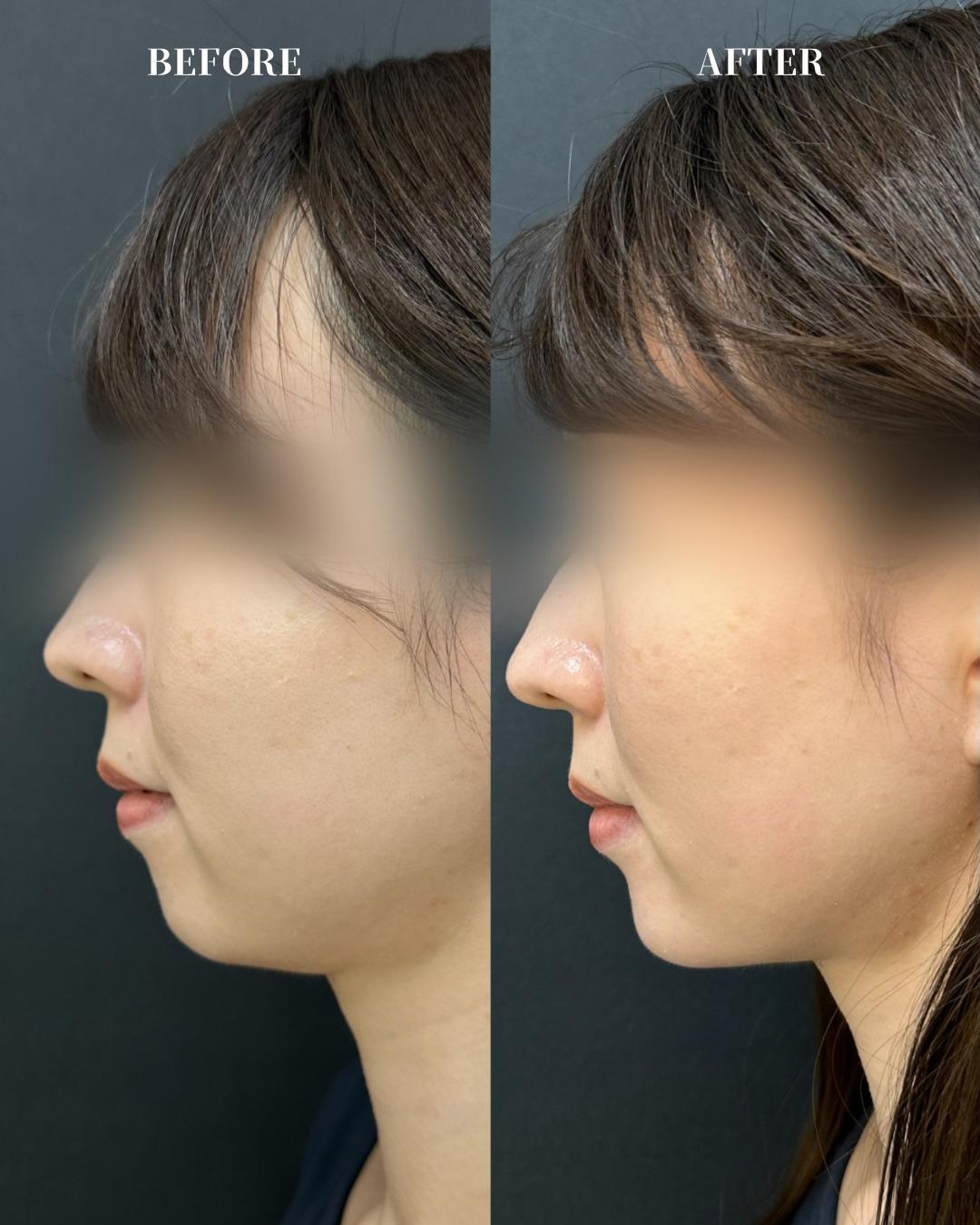 アゴクレヴィエルの症例写真