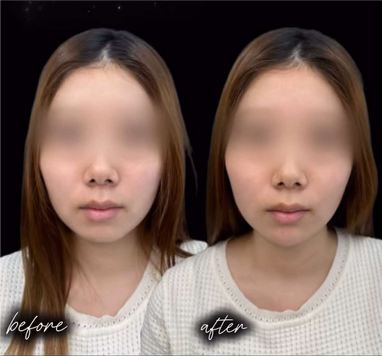 アゴクレヴィエルの症例写真