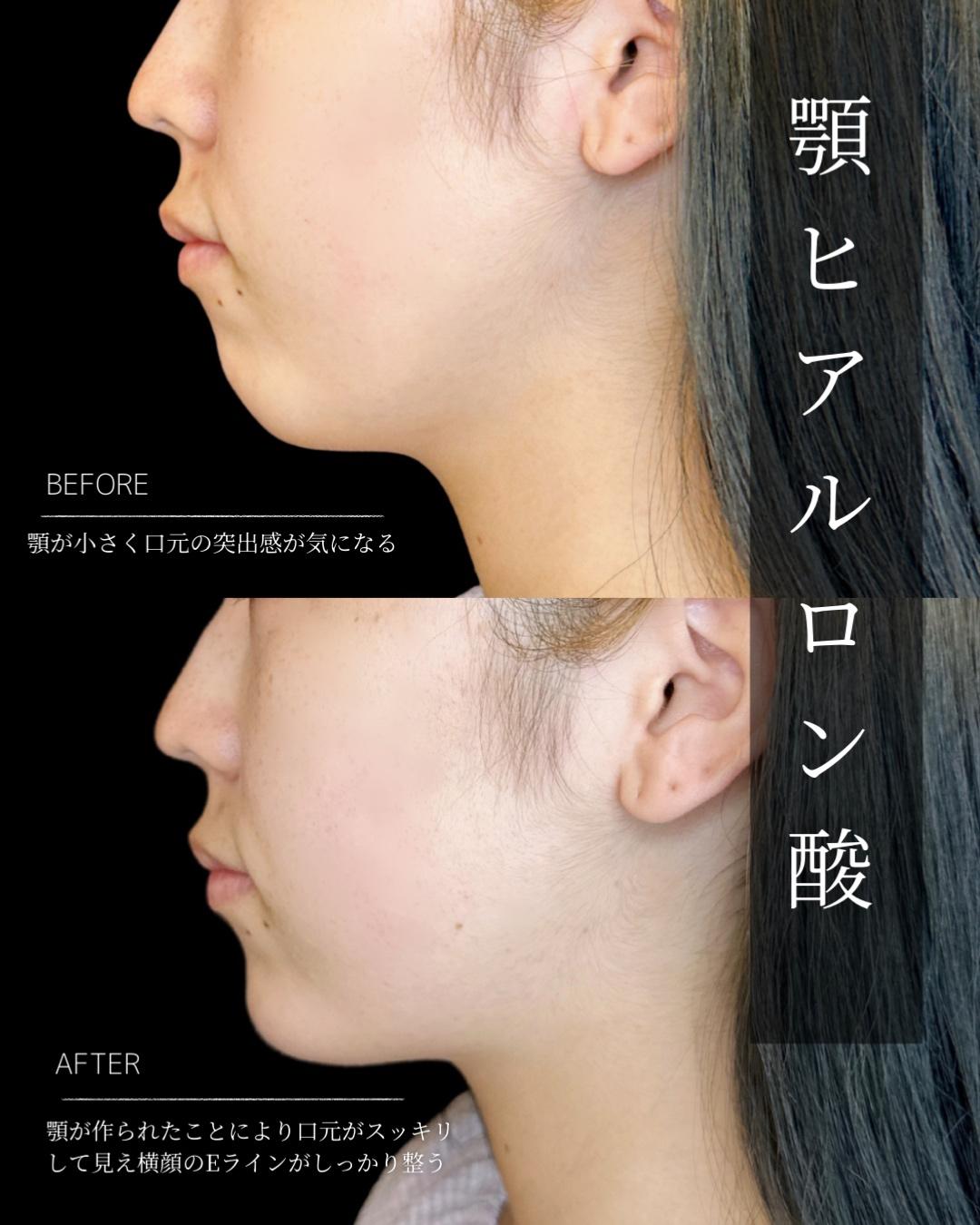 アゴクレヴィエルの症例写真