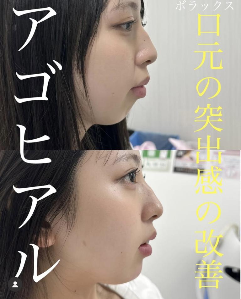 アゴクレヴィエルの症例写真