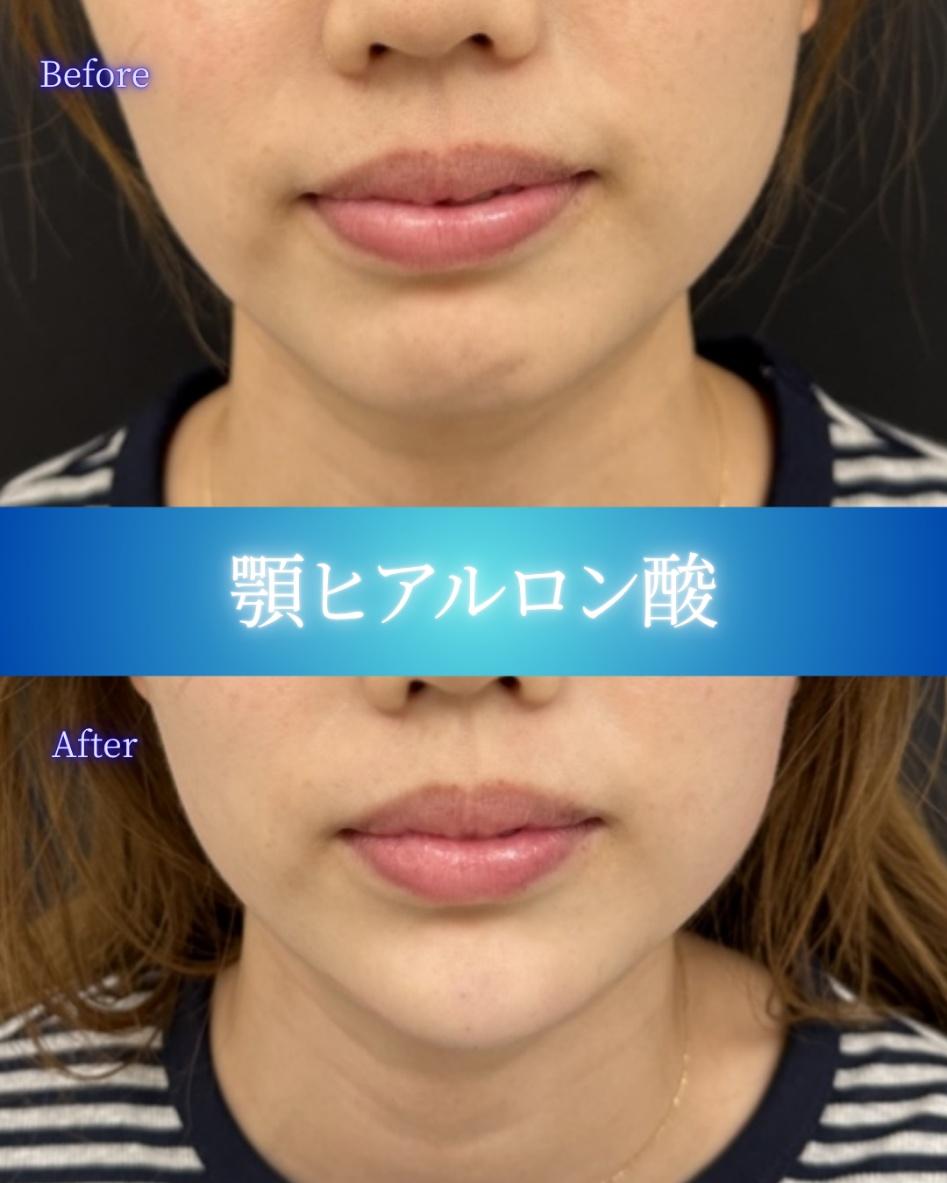 アゴクレヴィエルの症例写真