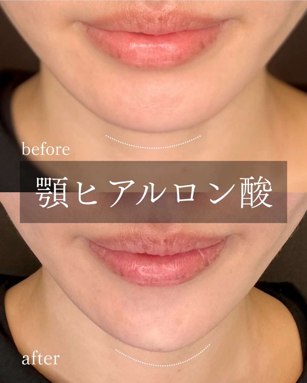 アゴクレヴィエルの症例写真