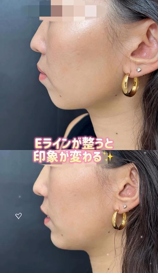 アゴクレヴィエルの症例写真