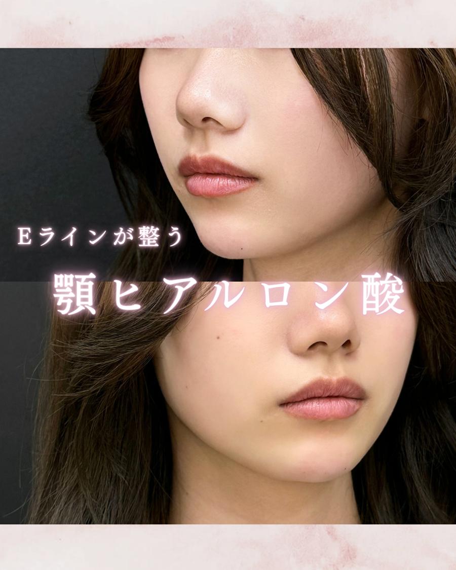 アゴクレヴィエルの症例写真