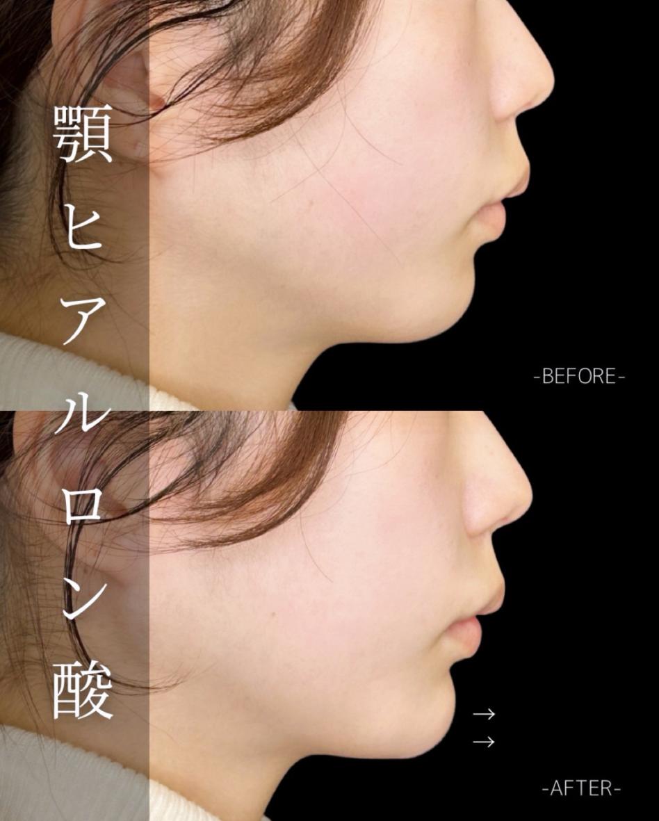 アゴクレヴィエルの症例写真