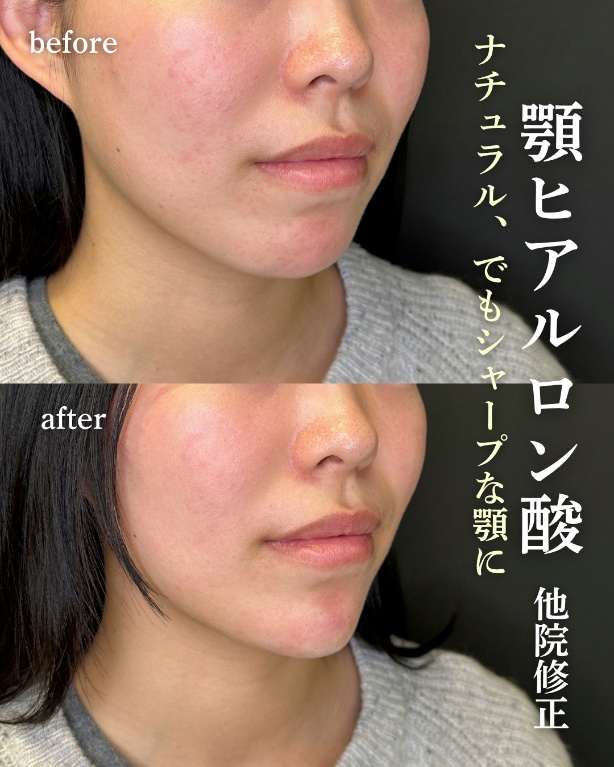 アゴクレヴィエルの症例写真