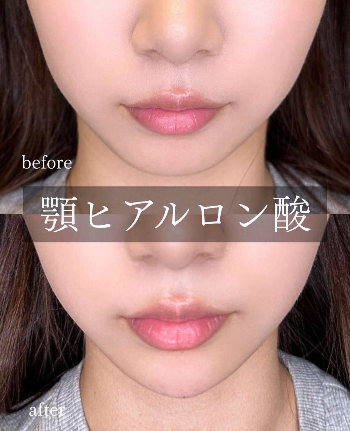 アゴクレヴィエルの症例写真