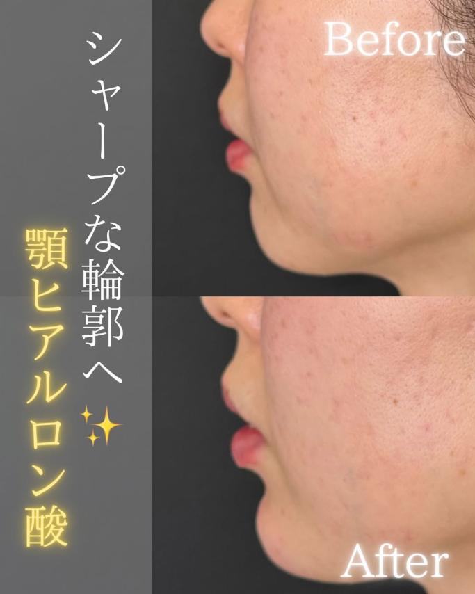 アゴクレヴィエルの症例写真