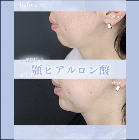 アゴクレヴィエルの症例写真