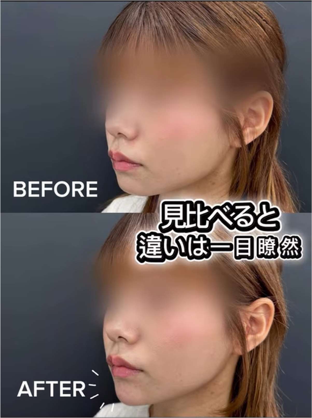 アゴクレヴィエルの症例写真