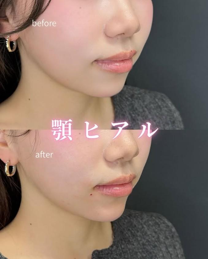 アゴクレヴィエルの症例写真