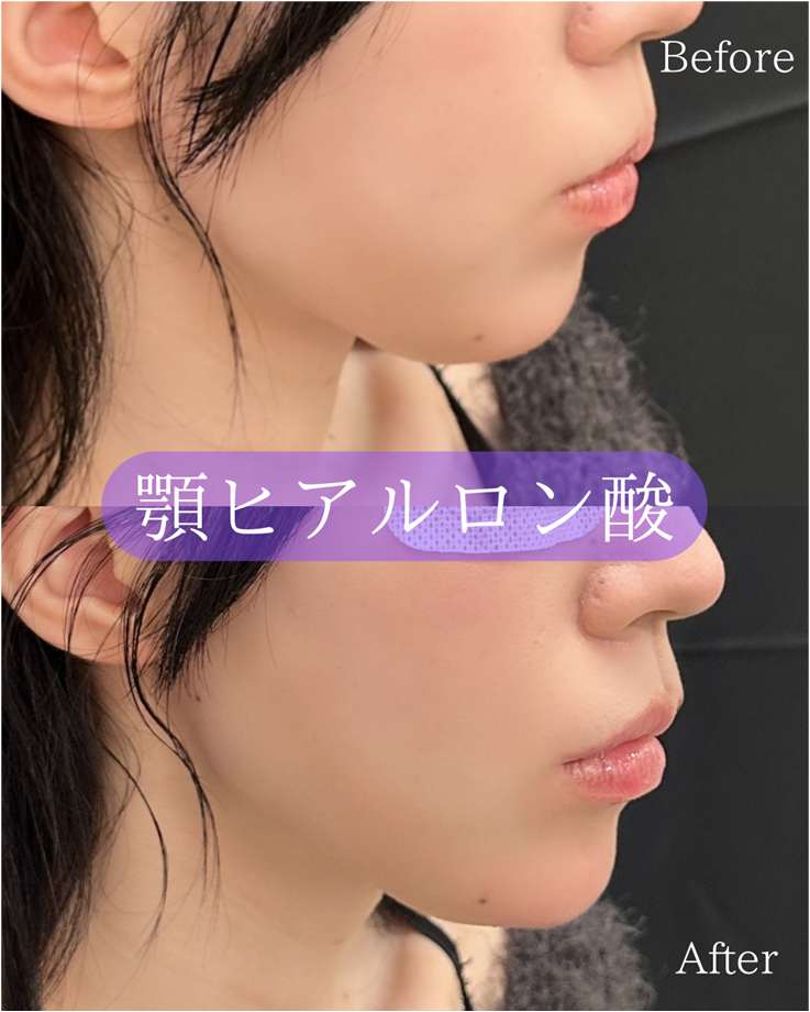 アゴクレヴィエルの症例写真