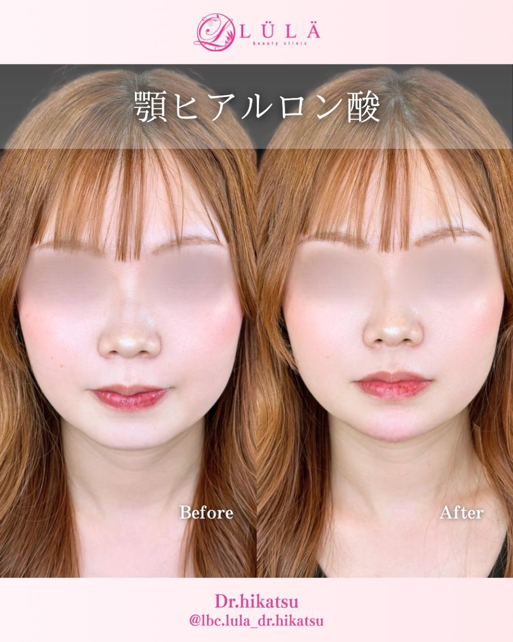 アゴクレヴィエルの症例写真