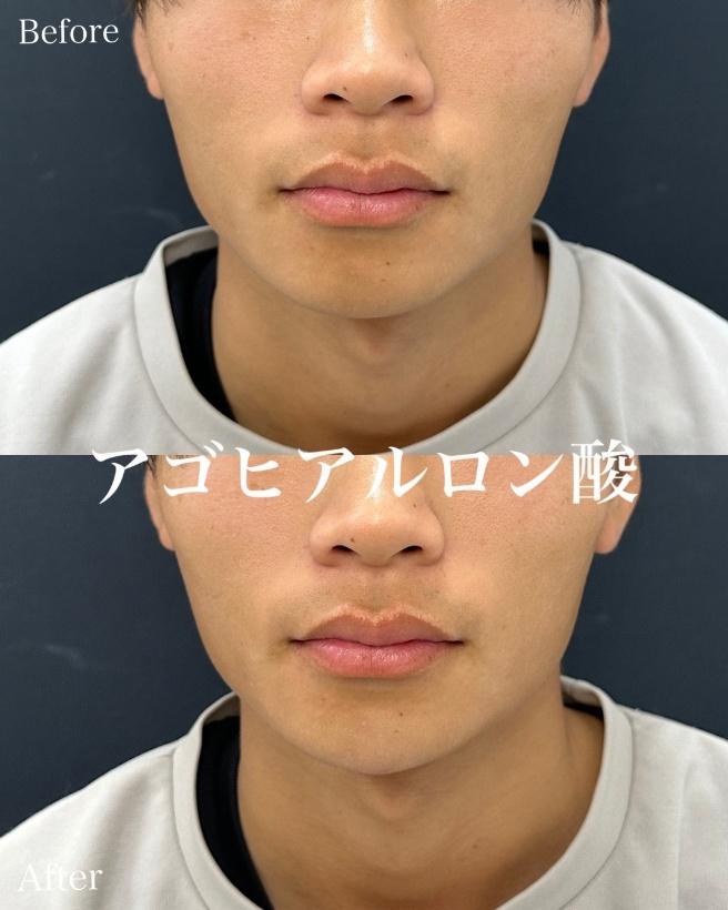 アゴクレヴィエルの症例写真