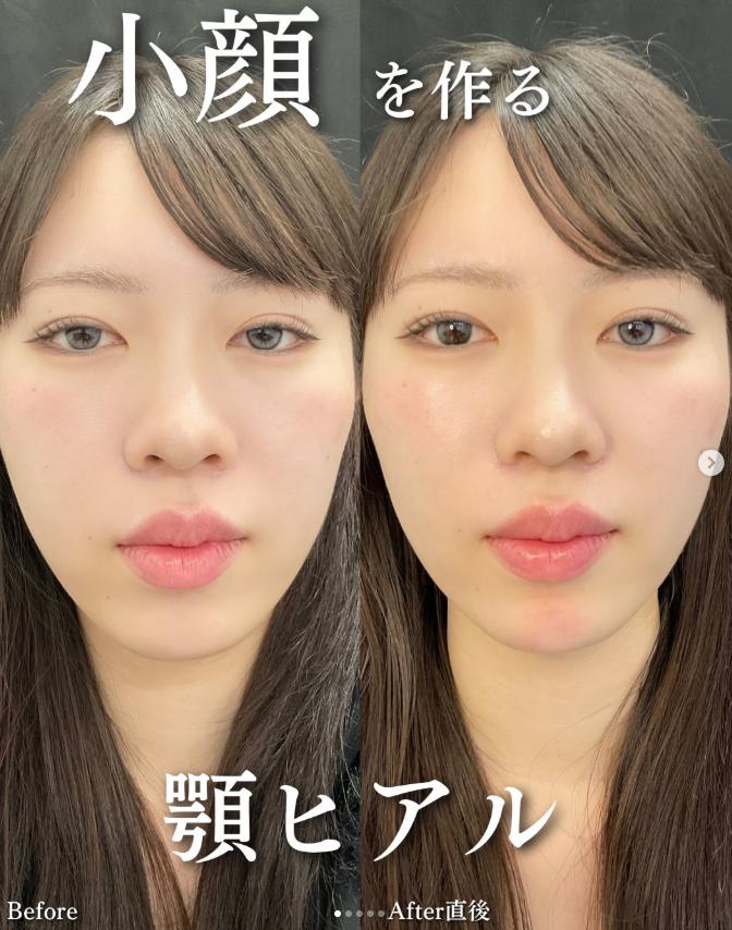 アゴクレヴィエルの症例写真