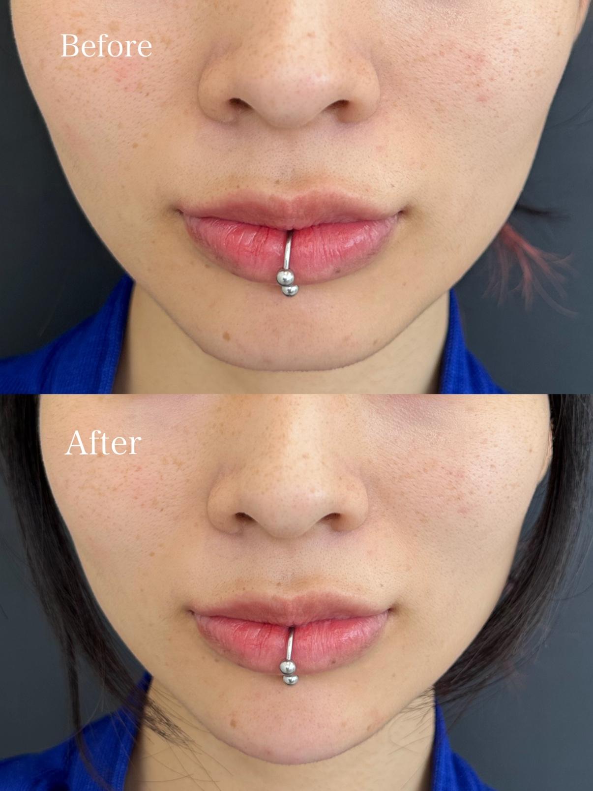 アゴクレヴィエルの症例写真