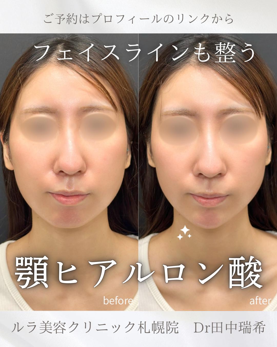 アゴクレヴィエルの症例写真