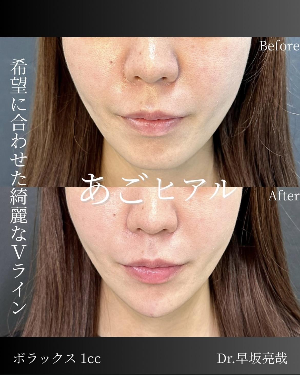 アゴクレヴィエルの症例写真