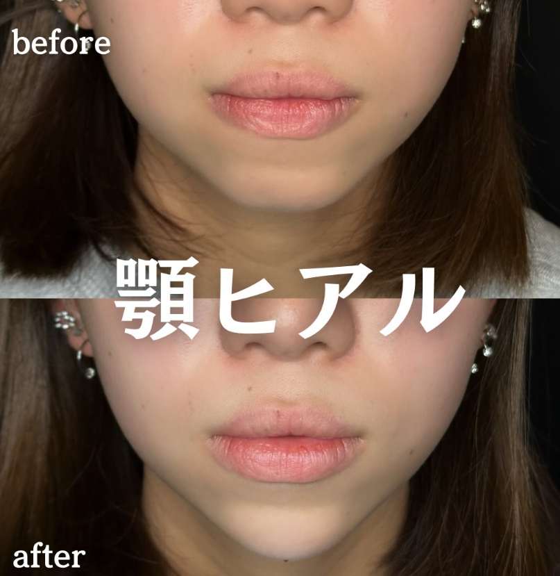 アゴクレヴィエルの症例写真