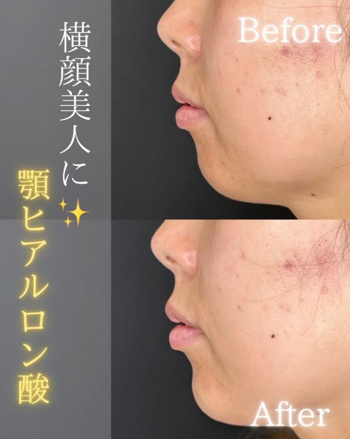 アゴクレヴィエルの症例写真