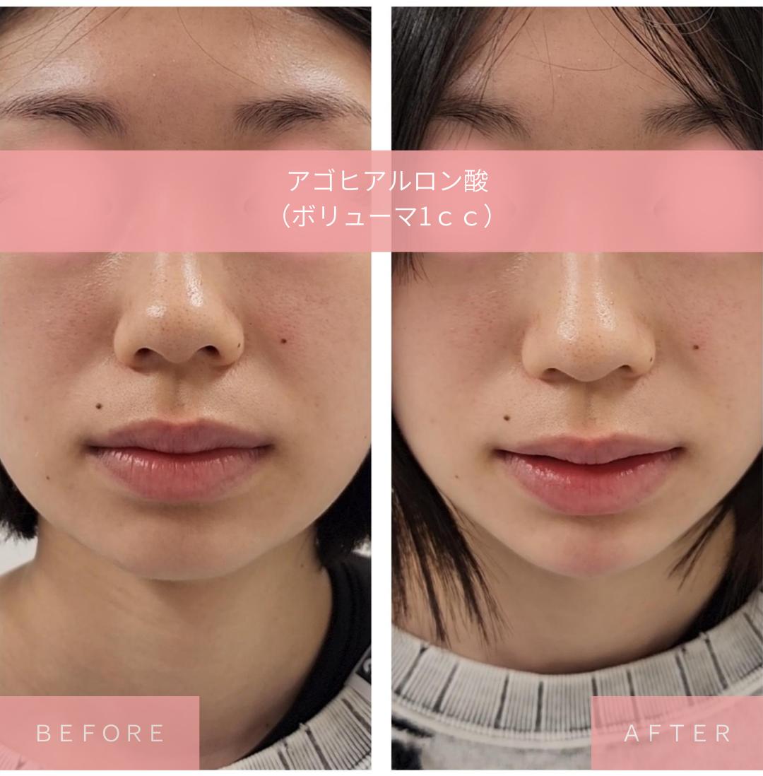 アゴクレヴィエルの症例写真