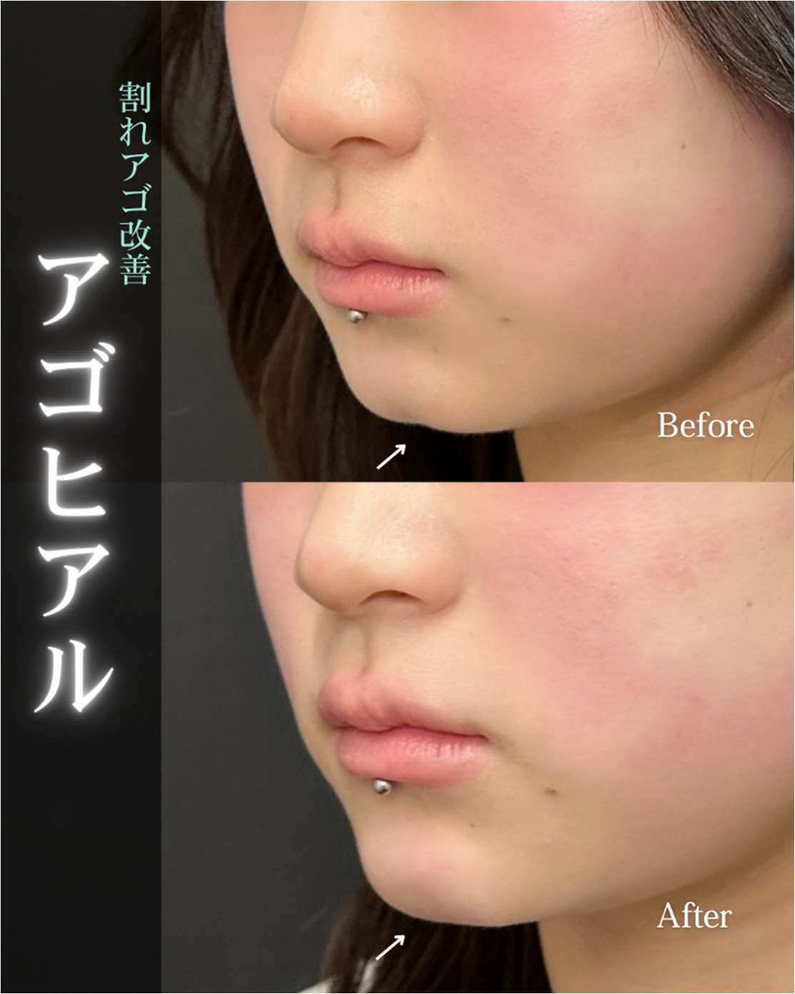 アゴクレヴィエルの症例写真